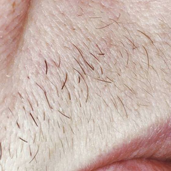 laser hair removal before