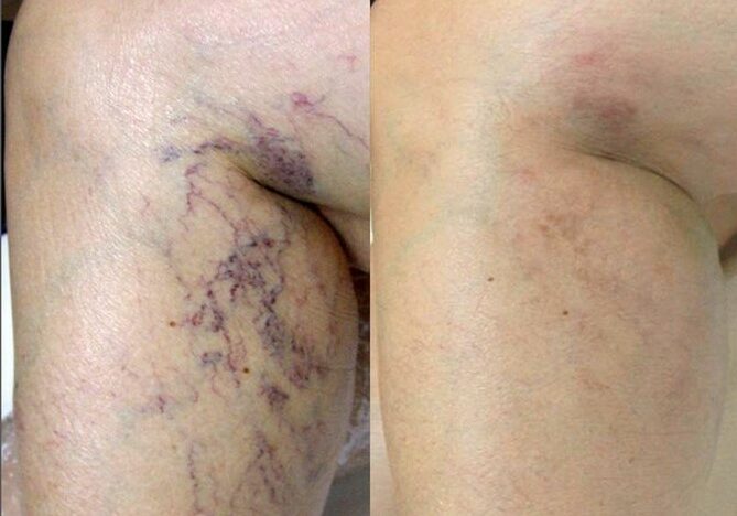 laser vein before and after