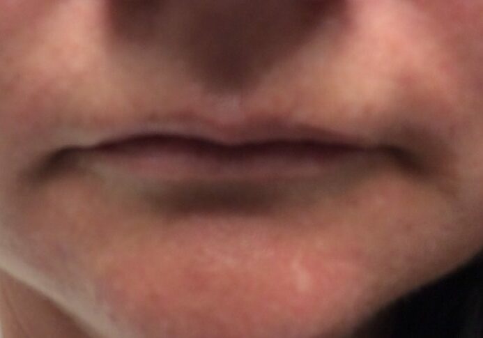 lips before fillers